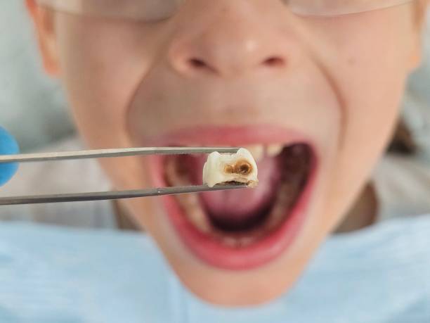 Best Emergency Wisdom Teeth Removal in Pecatonica, IL