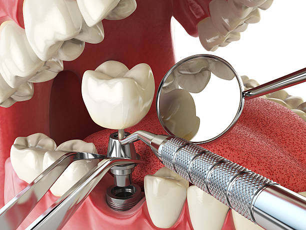 Best Emergency Tooth Extraction in Pecatonica, IL